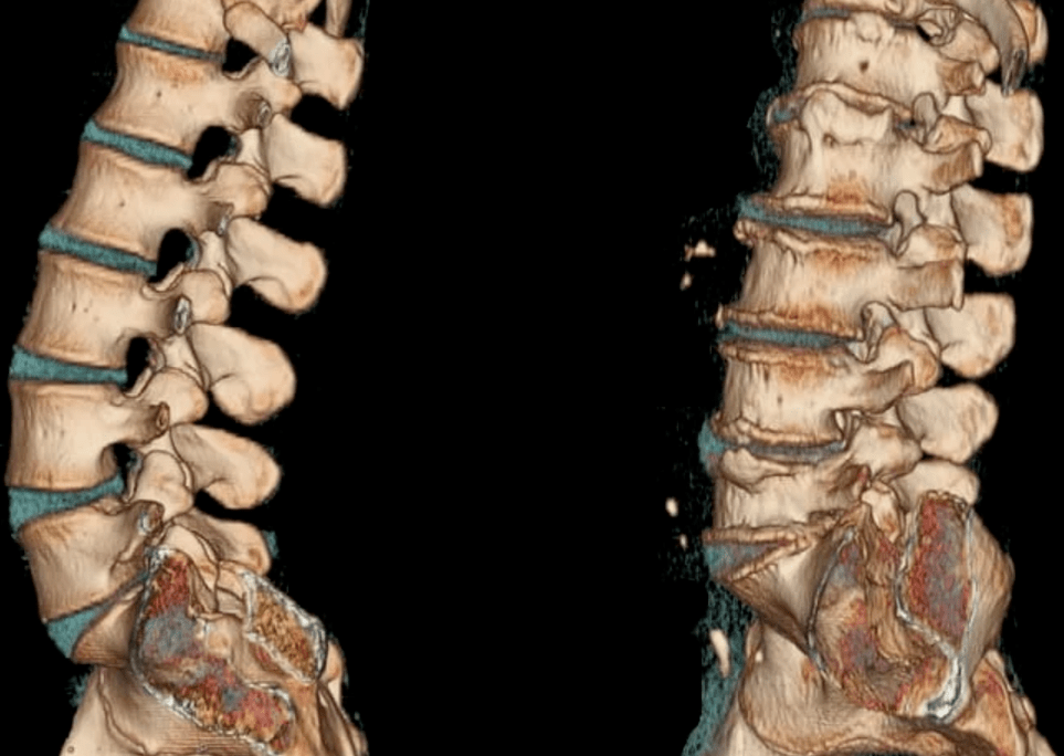 osteocondrosis