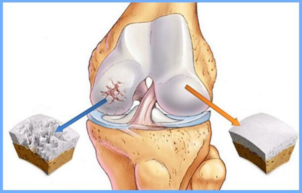 Affected by normal knee joints and osteoarthritis