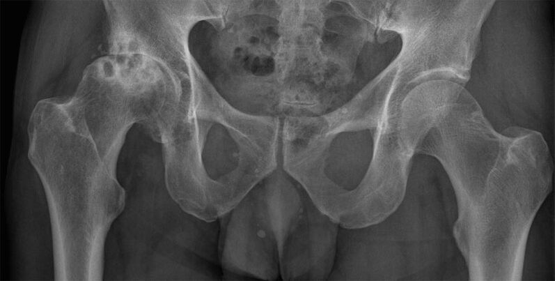 Deformation arthrosis of the hip joint on X-ray
