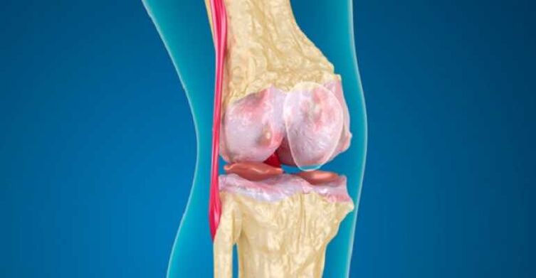 Arthrosis of knee common disease that causes the destruction of cartilage in compounds