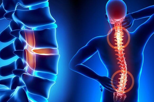 Osteochondrosis of the spine