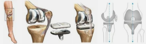 Prosthetic knee example