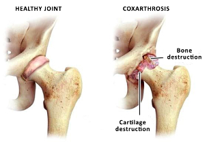 comparison of a healthy joint and hip sustav will